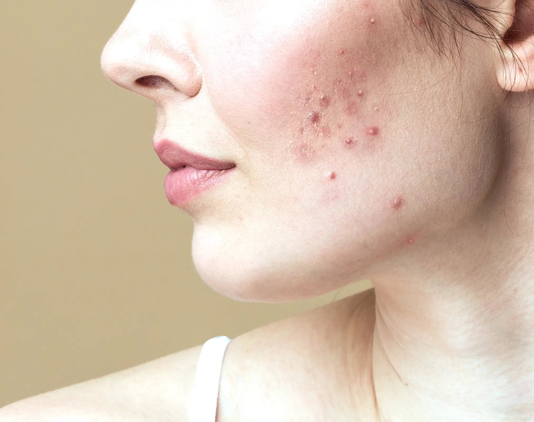 Natürliche Hilfe bei Pickeln und Unreinheiten